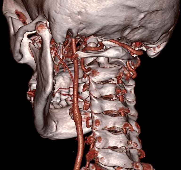 Arteria pellizcada con osteocondrose cervical