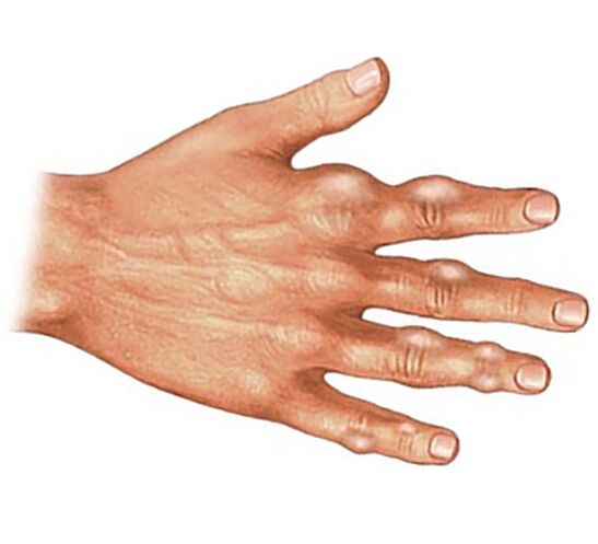 Deposición de cristais de ácido úrico nos tecidos brandos dos dedos na artrite gotosa