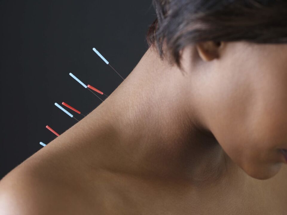 A acupuntura para a osteocondrose cervical elimina os procesos inflamatorios