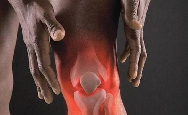 A osteoartrite vai acompañada dun proceso inflamatorio na articulación do xeonllo